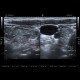 Lymphocytic thyroiditis: US - Ultrasound